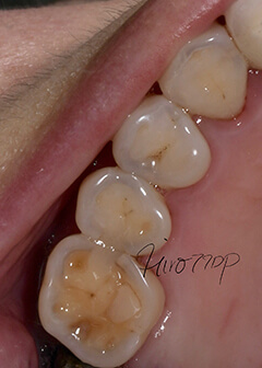 Attrition of upper right molars