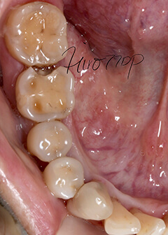 Attrition and caries in lower right molars