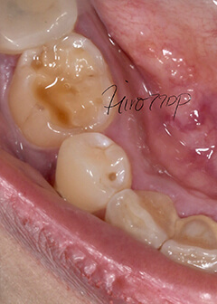 Attrition of molars and substantial build-up of tartar on the back of the lower front teeth