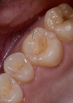 Eroded hollows in the left front teeth