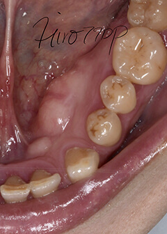 ttrition of molars and bone protuberance