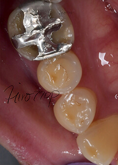 Attrition of silver-capped tooth