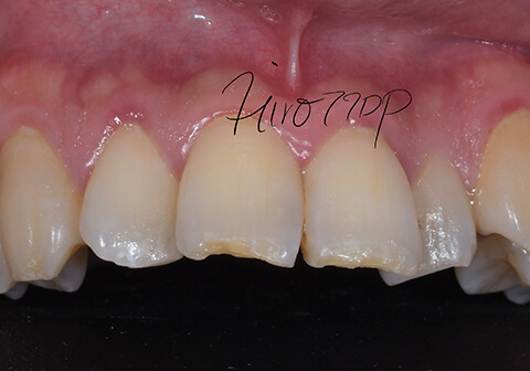Typical attrition of front teeth