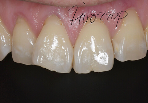 Attrition and cracking of front teeth