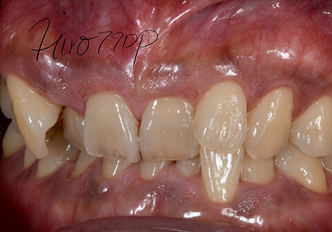 Attrition spreading throughout/ to the lower front teeth
