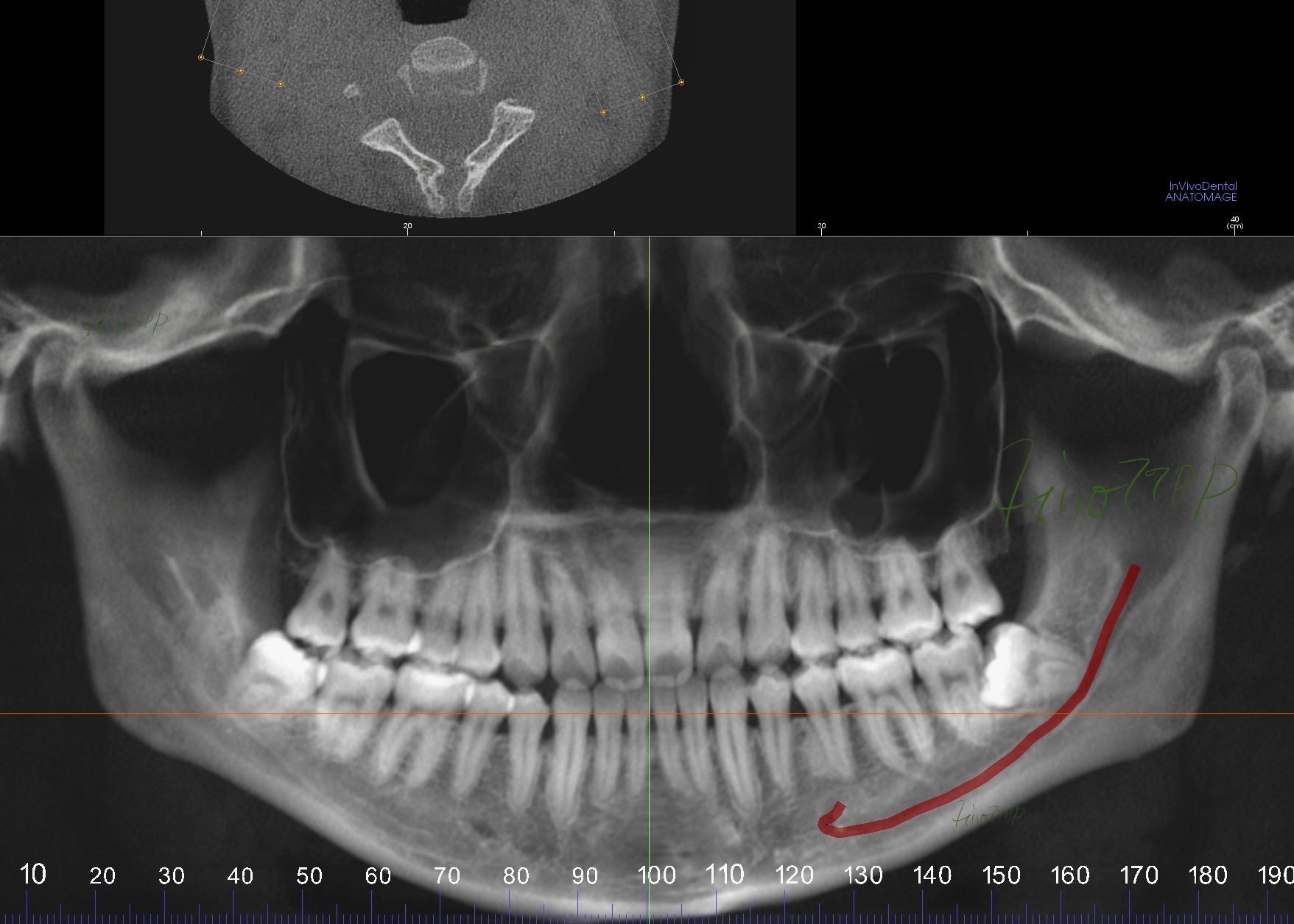 赤い線の部分が下歯槽神経（知覚神経）