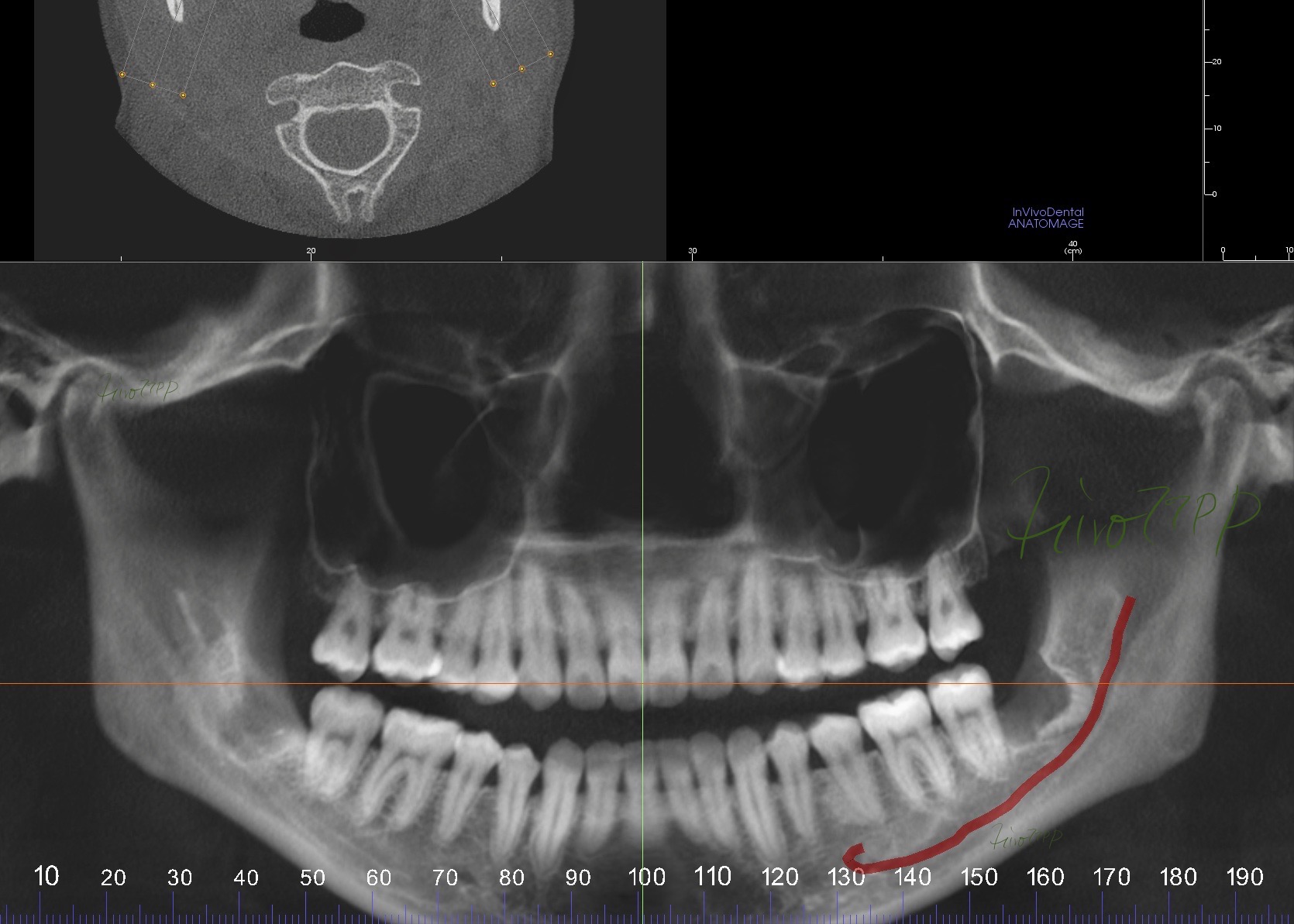 抜歯後 CTスーパーパノラマ写真