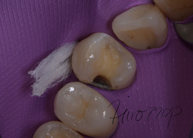 ラバーダム防湿・銀歯を除去・ダイレクトボンディング治療　ラバーダム防湿を実施