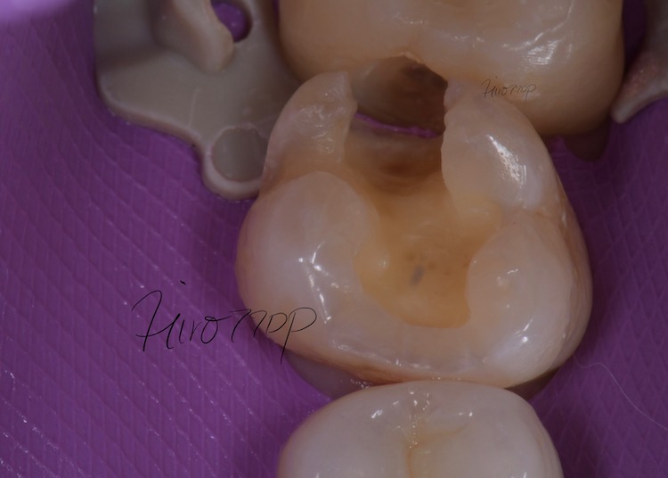 ラバーダム防湿・銀歯を除去・ダイレクトボンディング治療　一番奥の歯の様子
