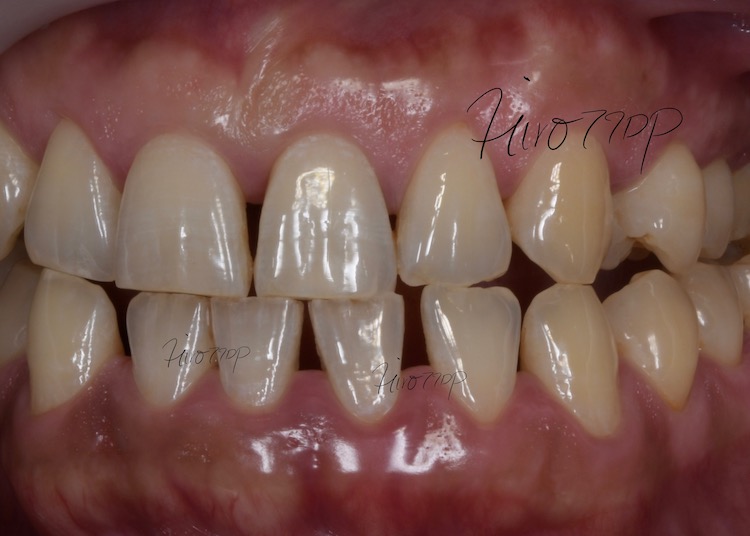 下前歯の隙間をダイレクトボンディング治療　治療前
