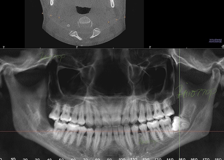 抜歯前 CTスーパーパノラマ写真