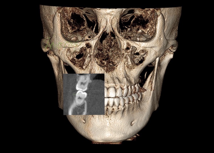かみ合わせと顎関節の精密検査&診査診断(Kavo CT)