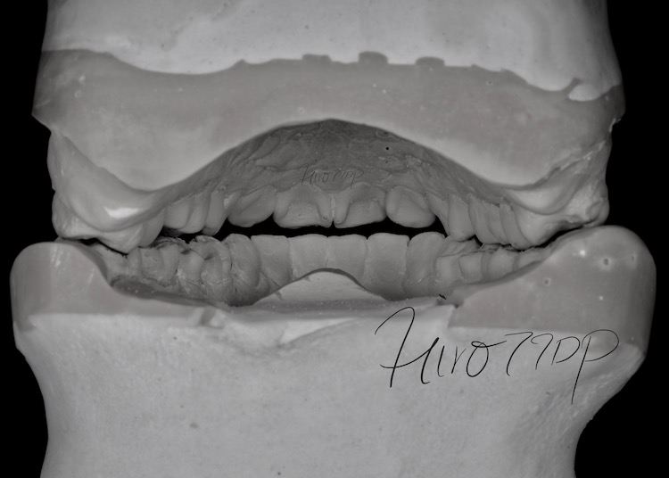 かみ合わせと顎関節の精密検査&診査診断　診断模型(後方から)