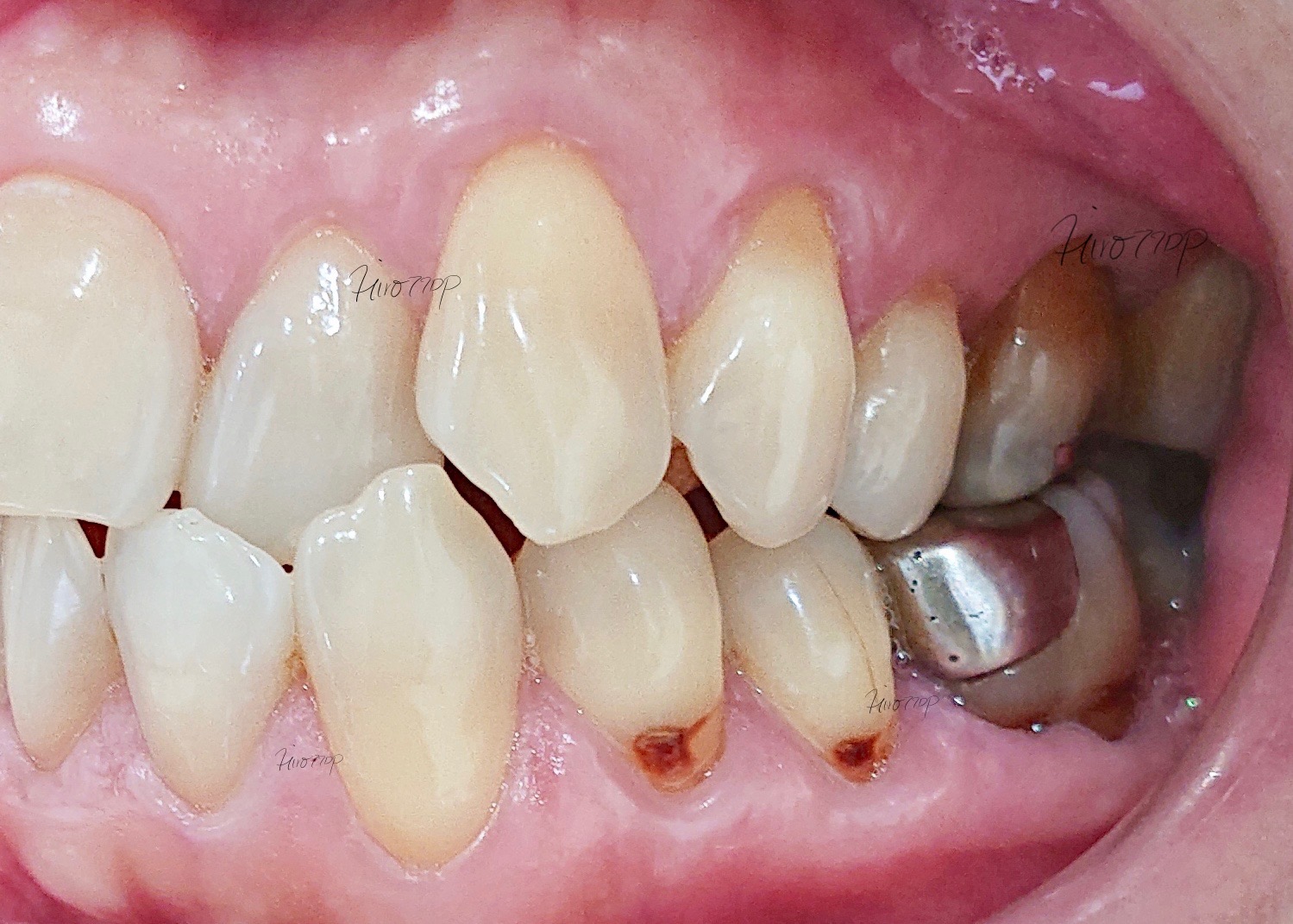 奥歯に銀歯や黒くなった部分を見ることができる