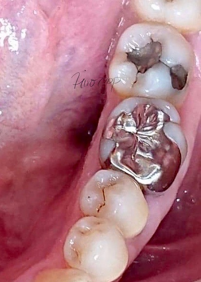 銀歯の歯とその前後の歯の並び（歯列）に乱れがあった