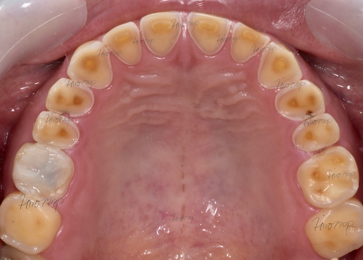 歯の神経の入り口が見えているが、神経は保存可能