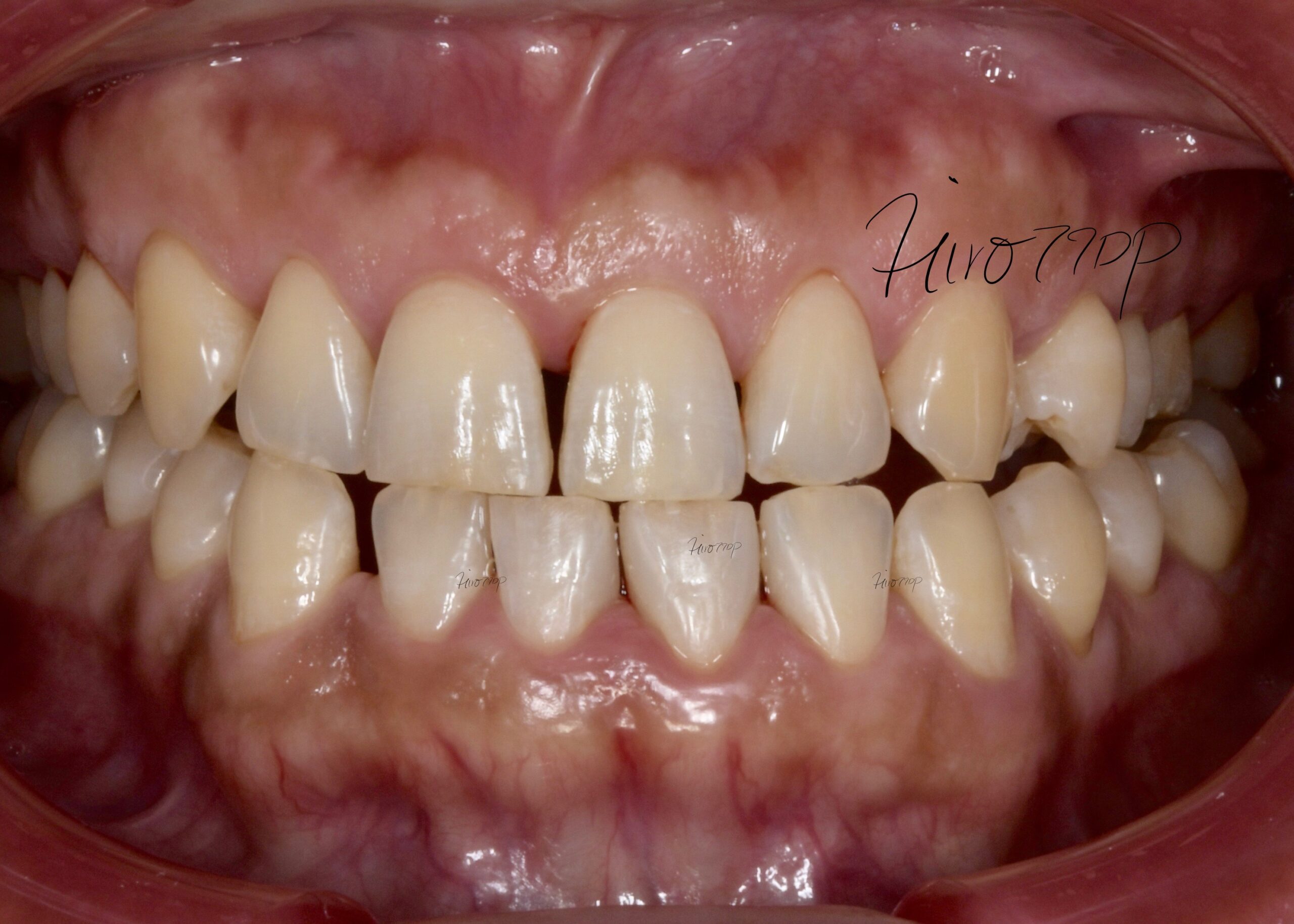 下前歯の隙間をダイレクトボンディング治療　治療後