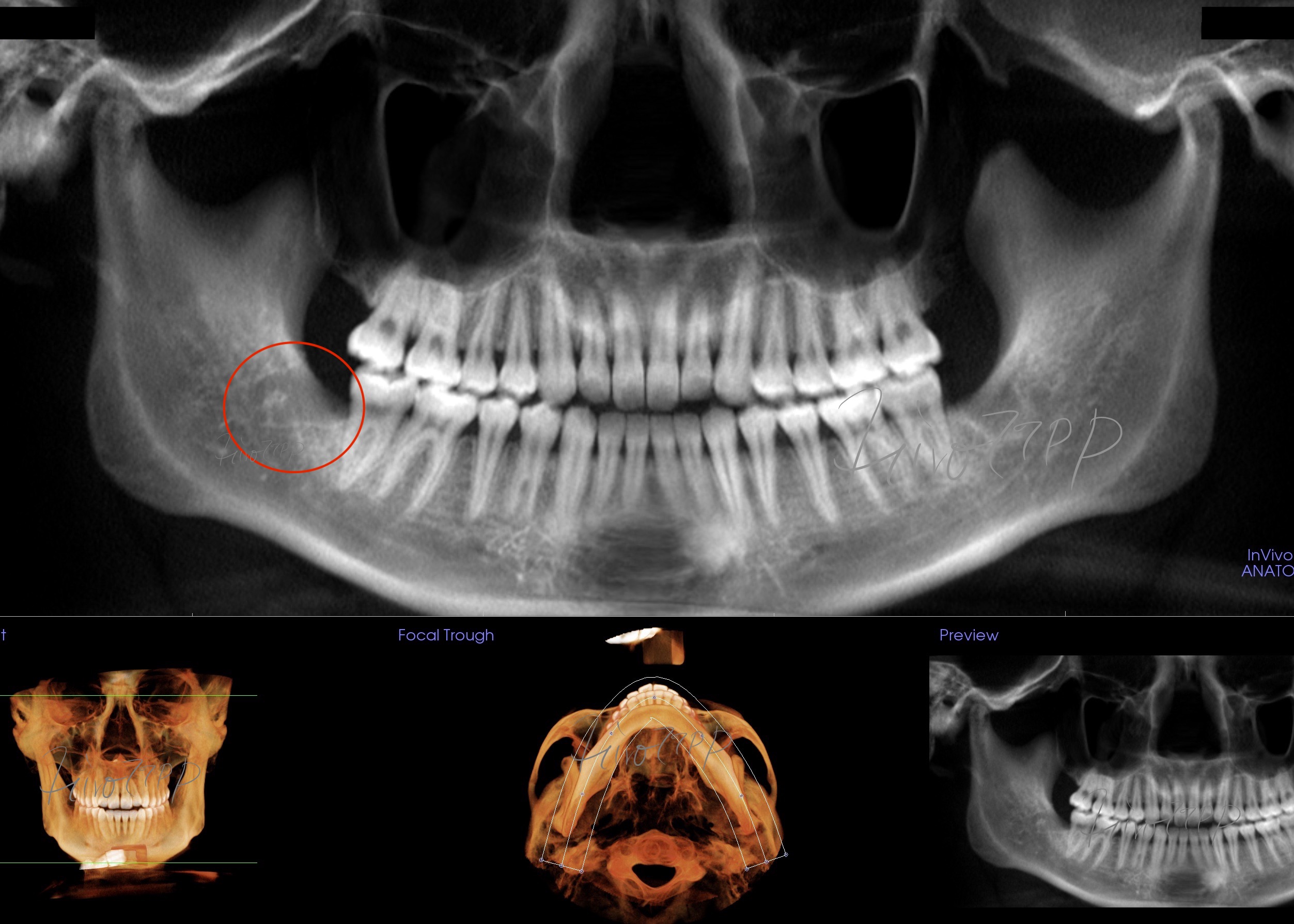 抜歯後 CTスーパーパノラマ写真