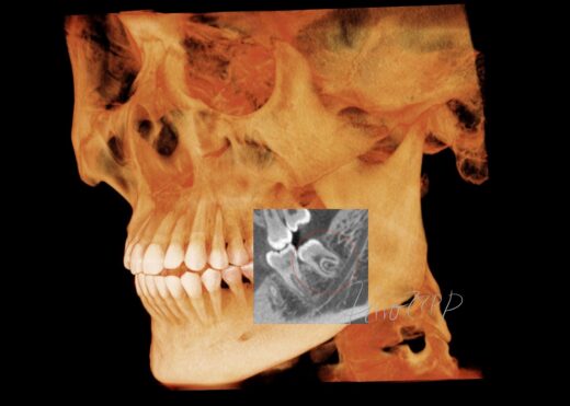 親知らず難抜歯（左下の骨の中）ケース