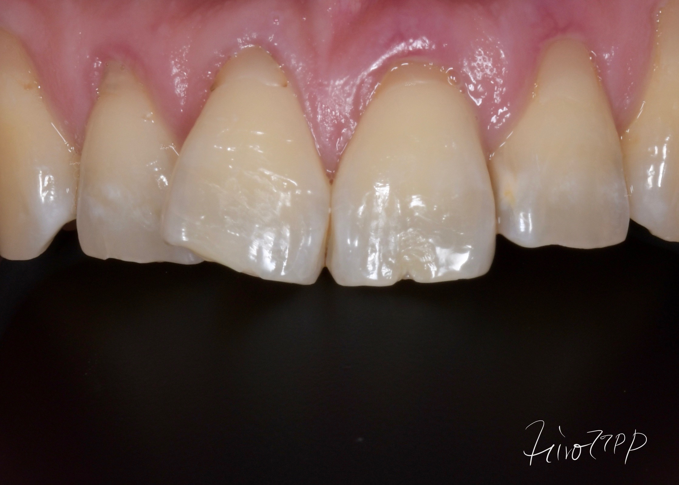 前歯の接触が強く、咬耗により、歯の先に亀裂と一部かけている