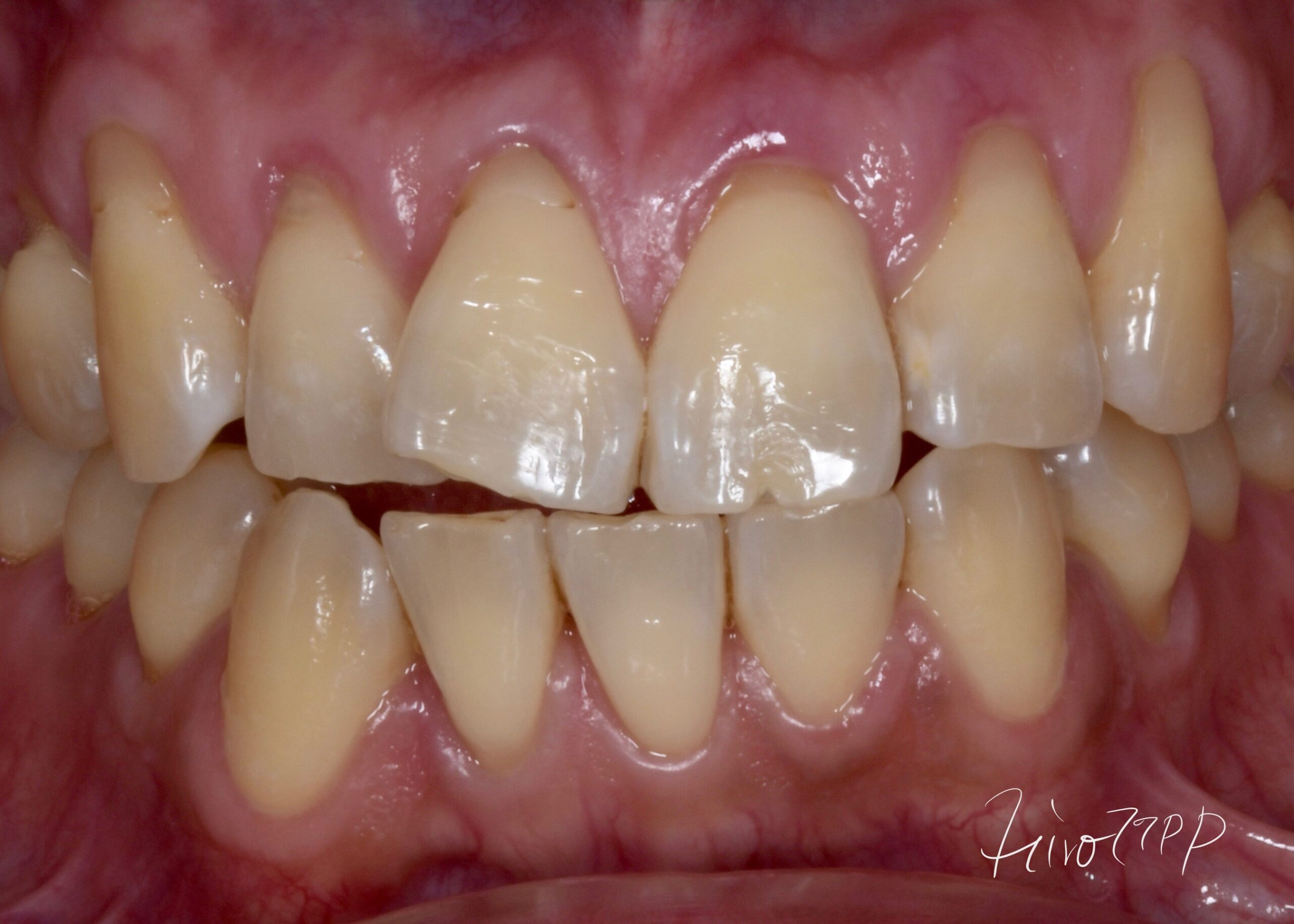 歯の色は黄色味が強く、白さとその維持・安定のために、ホワイトニングの回数を多く必要