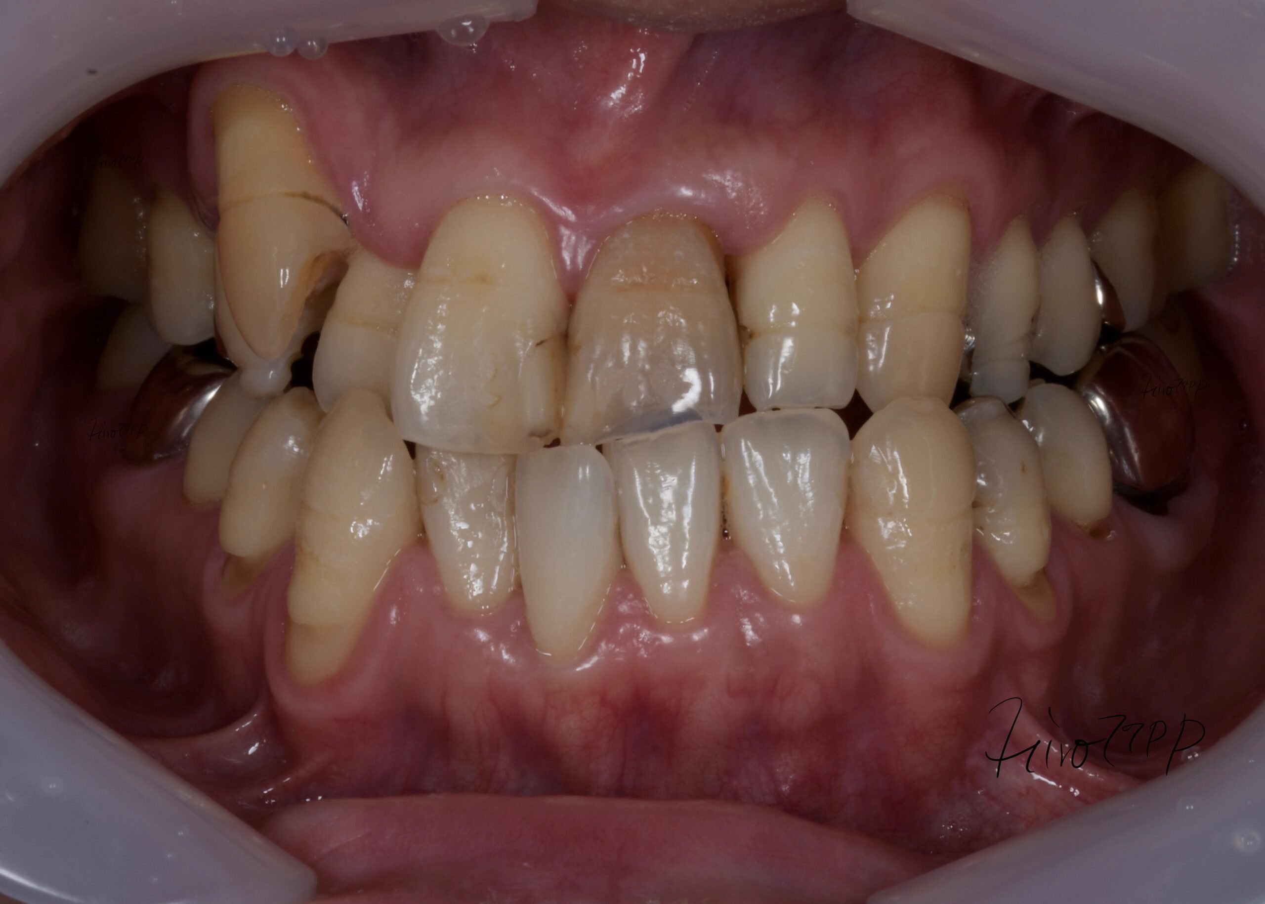 矯正治療なしでかみ合わせと前歯の審美治療　治療前(正面)