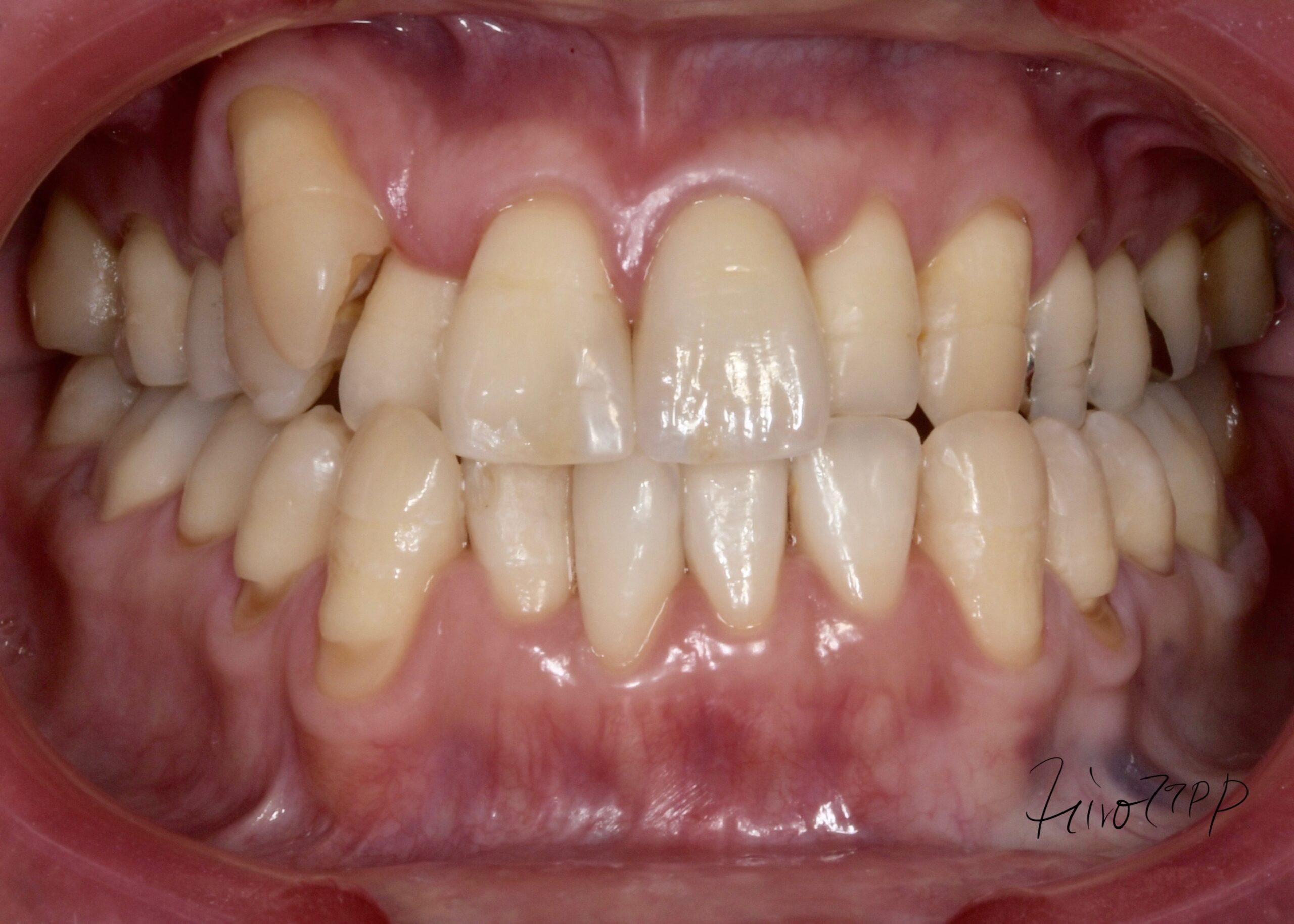 矯正治療なしでかみ合わせと前歯の審美治療　治療後　かみ合わせた状態（正面）