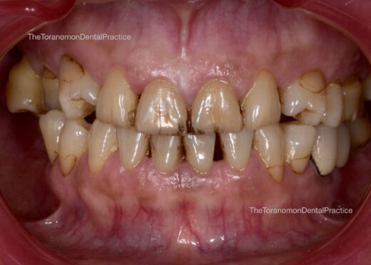 (歯科恐怖症)クリーニング&ホワイトニング&ダイレクトボンディングで見た目の回復をしたケース