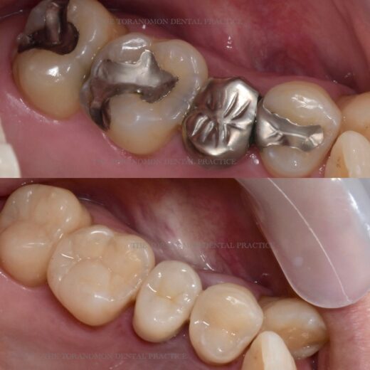No.5 銀歯を除去してダイレクトボンディング治療を行ったケース（ステージ2）