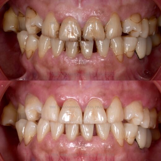 No.27 (歯科恐怖症)クリーニング&ホワイトニング&ダイレクトボンディングで見た目の回復をしたケース